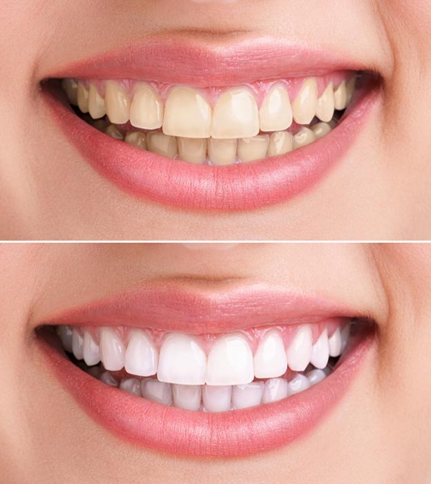 Here Are Our Recommendations For Teeth Whitening Strips