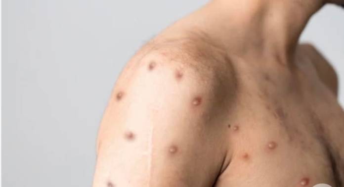 Monkeypox cases triple in Europe, WHO says